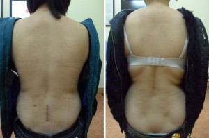 bệnh nhân cấy chỉ