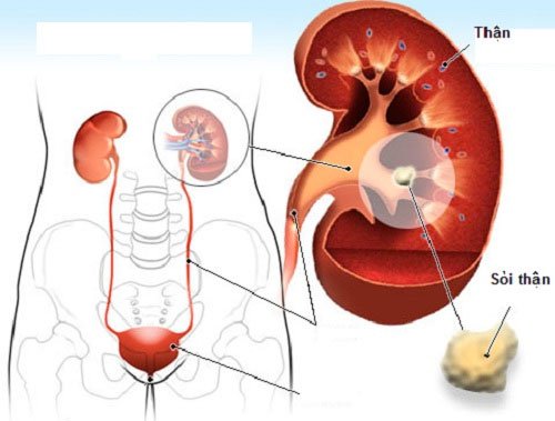 Tất cả về bệnh sỏi thận