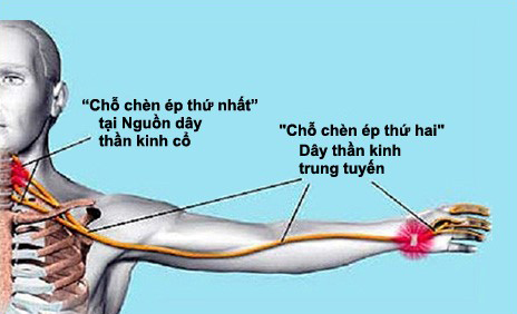 đau cổ tay
