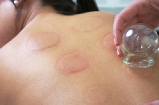 giác hơi chữa bệnh
