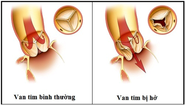 Bác sĩ ơi: Hở van tim 1/4 có đáng lo?
