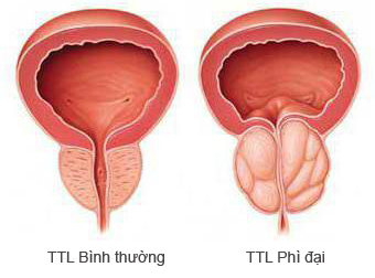 Dấu hiệu nhận biết phì đại tuyến tiền liệt