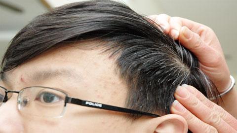tóc bạc sớm