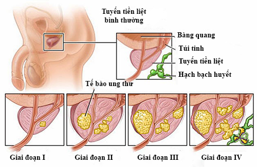 Làm sao để phát hiện ung thư tuyến tiền liệt đang tấn công bạn?